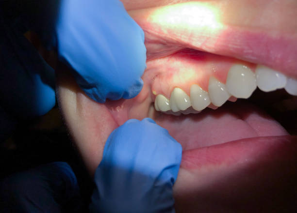 Best Knocked-Out Tooth (Avulsed Tooth) Treatment in Clifton, CO